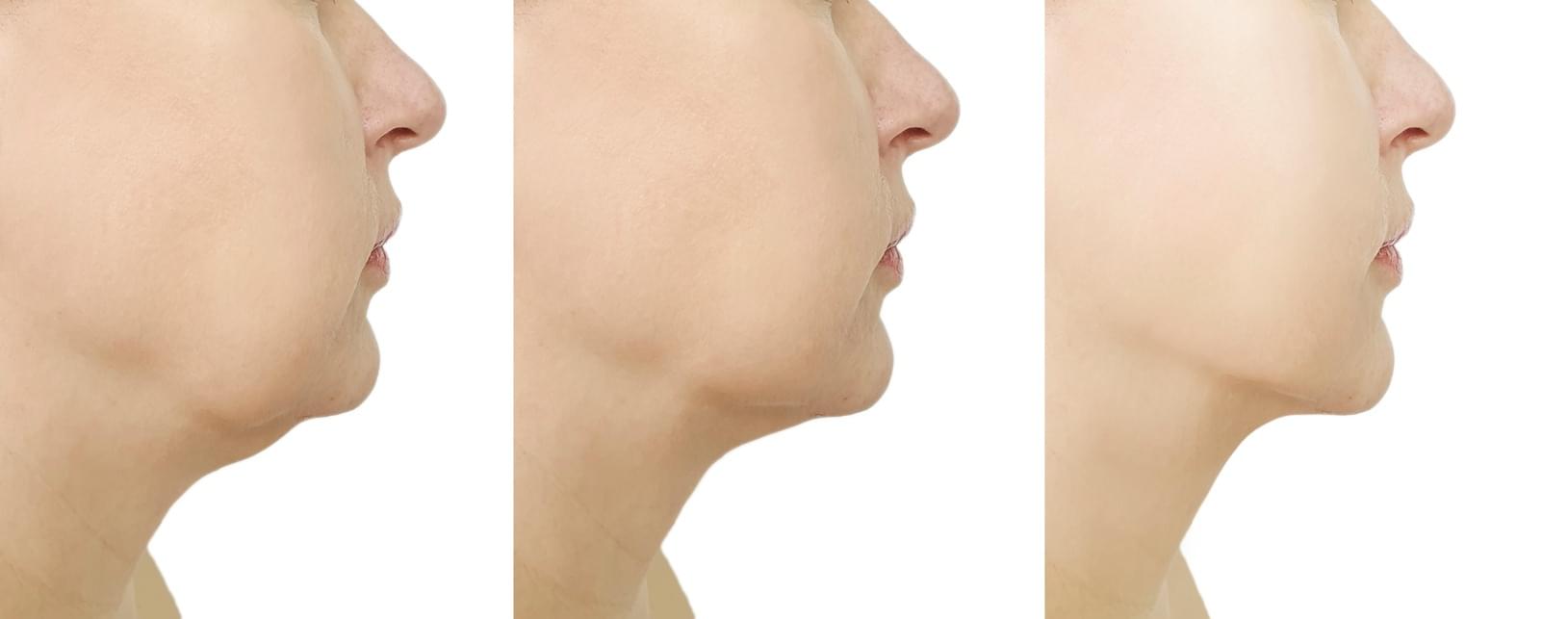 Benefits of our CryoChin double-chin slimming service